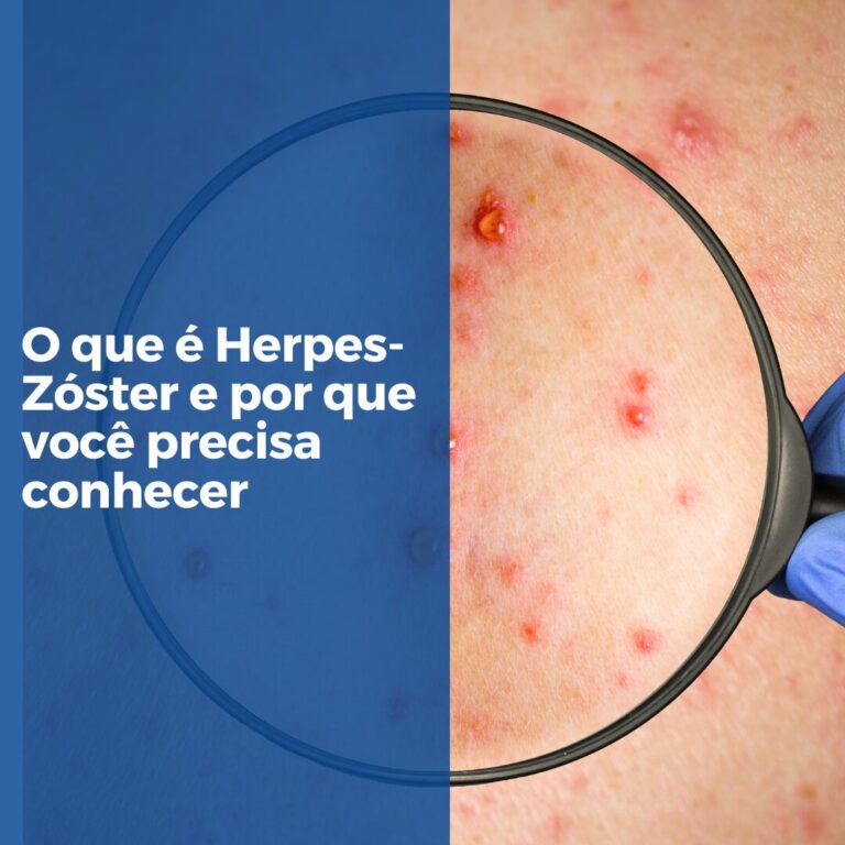 O que é Herpes-Zóster e por que você precisa conhecer?